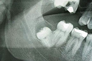 Ejemplo de cirugía dentoalveolar preprotésica